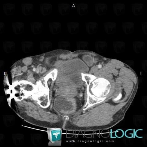 Rectal cancer, Rectum, CT