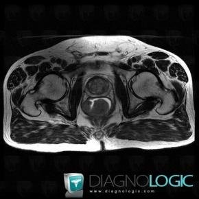 Rectal cancer, Rectum, MRI