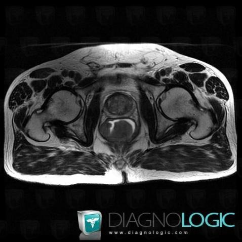 Rectal cancer, Rectum, MRI