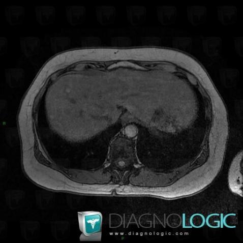 Regenerating nodule, Liver, MRI