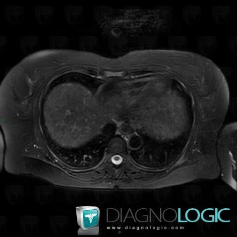 Regenerating nodule, Liver, MRI