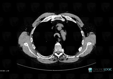 Relapsing polychondritis, Airways, CT