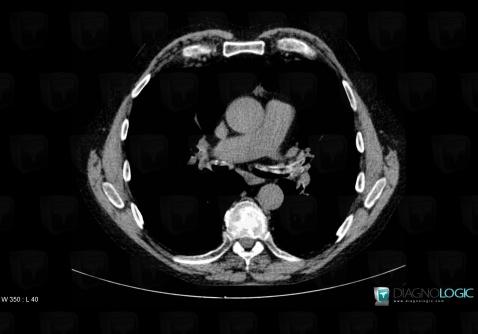 Relapsing polychondritis, Airways, CT