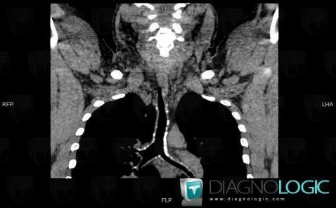 Relapsing polychondritis, Airways, CT