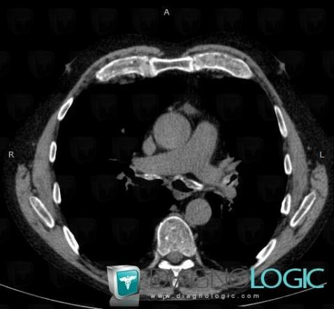 Relapsing polychondritis, Airways, CT