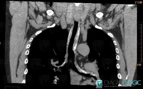 Relapsing polychondritis, Airways, CT