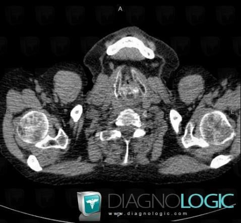 Relapsing polychondritis, Larynx, CT