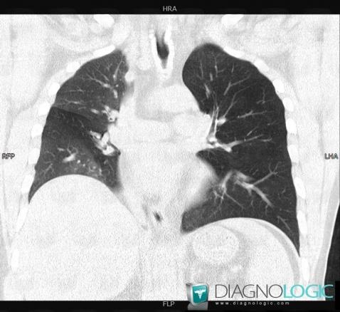 Relapsing polychondritis, Pulmonary parenchyma, CT