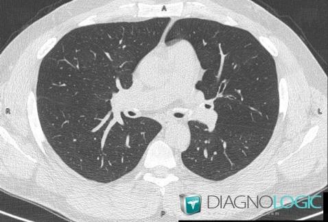 Relapsing polychondritis, Pulmonary parenchyma, CT