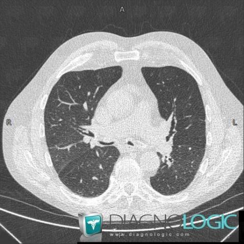 Relapsing polychondritis, Pulmonary parenchyma, CT