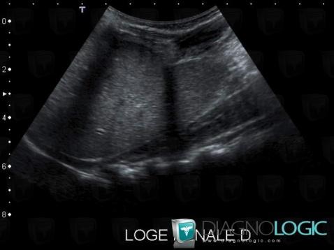 Renal agenesis, Kidney, US