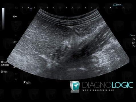 Renal agenesis, Kidney, US