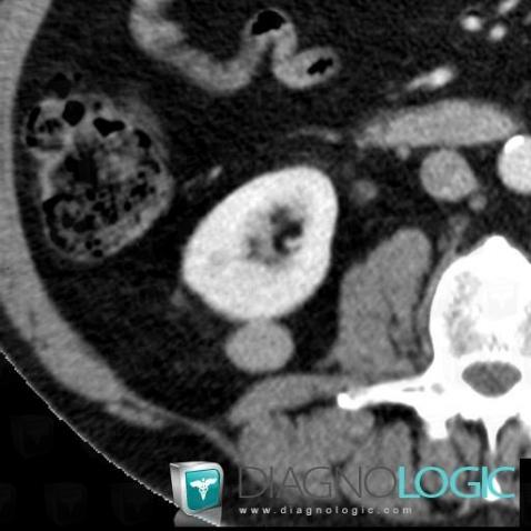 Renal cyst / Bosniak II , Kidney, CT