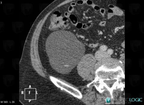 Renal cyst / Bosniak II , Kidney, CT