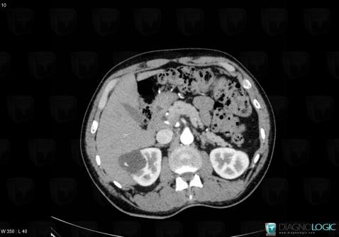 Renal cyst / Bosniak II , Kidney, CT