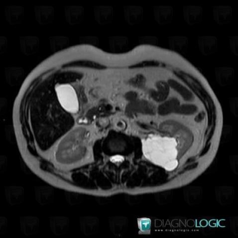 Renal cyst / Bosniak II , Kidney, MRI