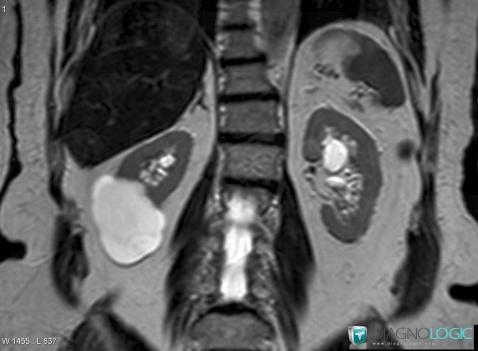 Renal cyst / Bosniak II , Kidney, MRI