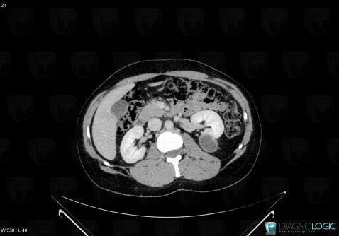 Renal cyst / Bosniak III , Kidney, CT