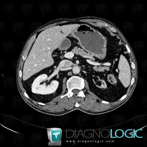 Renal hypoplasia, Kidney, CT