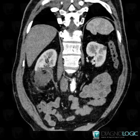 Renal infarction, Kidney, CT