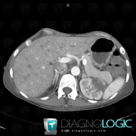 Renal infarction, Kidney, CT