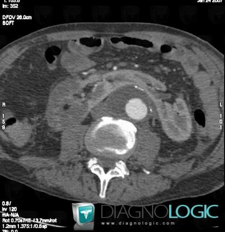 Renal infarction, Kidney, CT