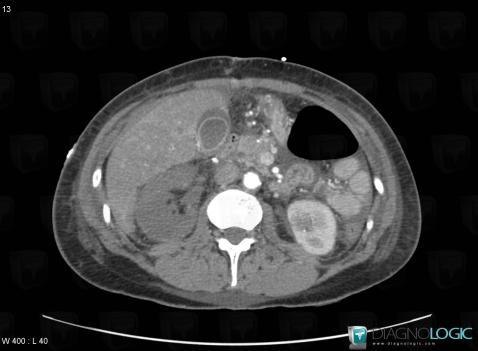 Renal infarction, Kidney, CT