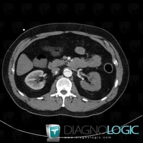 Renal infarction, Kidney, CT