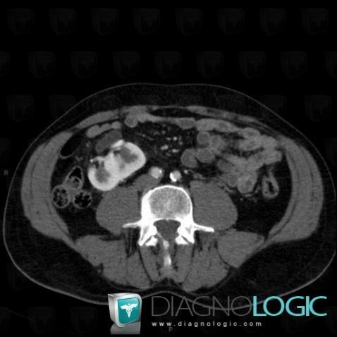 Renal malrotation, Kidney, CT