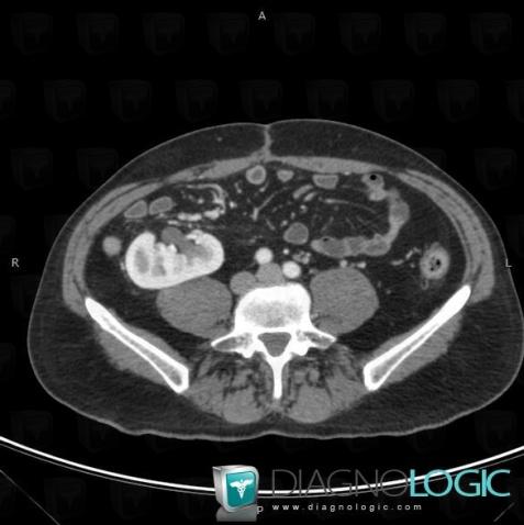 Renal malrotation, Kidney, CT