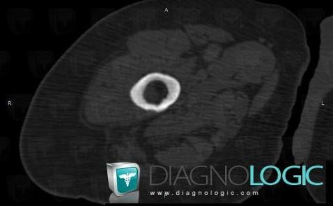 Renal osteodystrophy, Femur - Mid part, CT