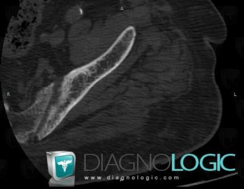 Renal osteodystrophy, Sacro iliac joint, CT