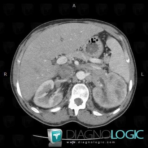 Renal vein thrombosis, Other veins - Abdomen, CT