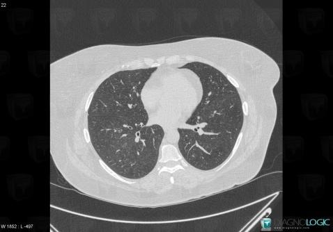 Respiratory bronchiolitis, Airways, CT