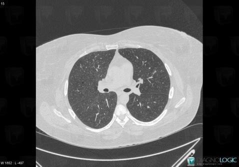 Respiratory bronchiolitis, Pulmonary parenchyma, CT