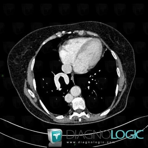 Retour veineux pulmonaire anormal, Veines - Thorax, Scanner