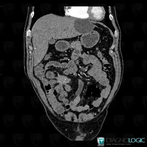 Retractile mesenteritis, Mesentery / Peritoneum, CT