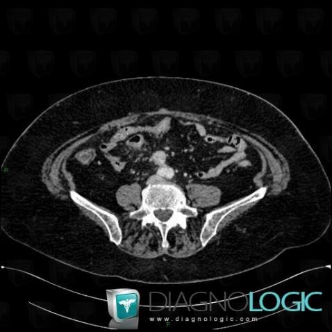 Retractile mesenteritis, Mesentery / Peritoneum, CT