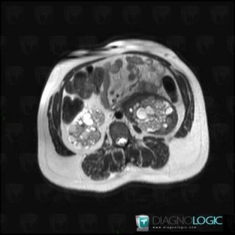 Retroperitoneal fibrosis, Kidney, MRI