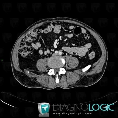 Retroperitoneal fibrosis, Retroperitoneum, CT