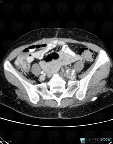 Retroperitoneal fibrosis, Retroperitoneum, CT