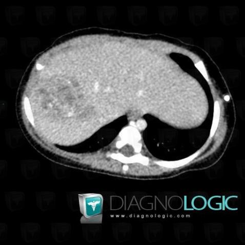 Rhabdoid tumor, Liver, CT