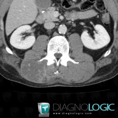 Rhabdomyolysis , Paraspinal, CT