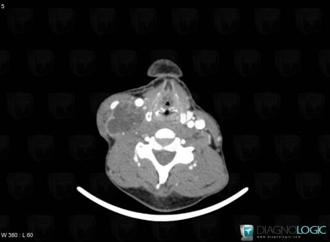 Rhabdomyosarcoma, Deep neck spaces, CT