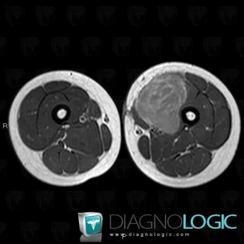 Rhabdomyosarcoma, Muscles - Thigh, MRI