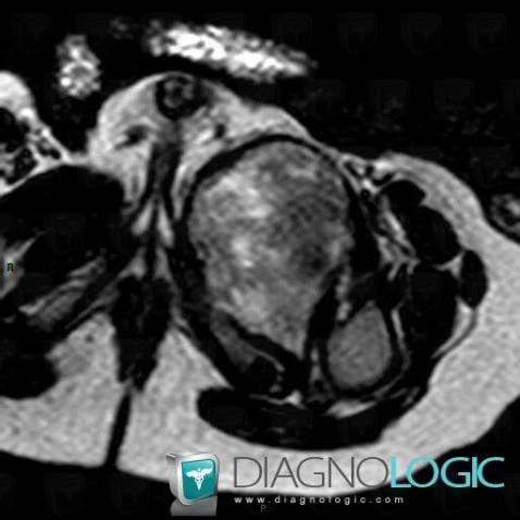 Rhabdomyosarcoma, Pelvic Muscles, Other soft tissues/nerves - Pelvis, MRI