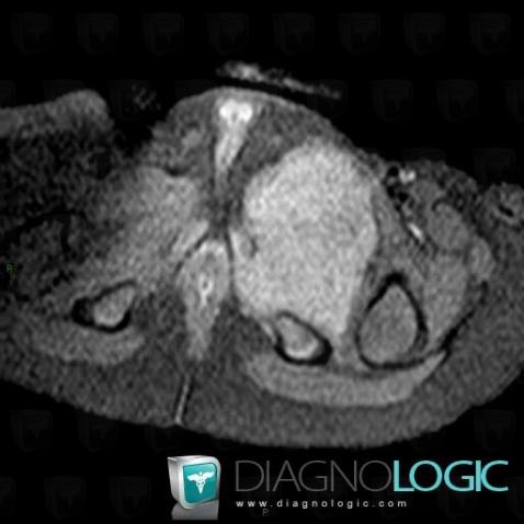 Rhabdomyosarcoma, Pelvic Muscles, Other soft tissues/nerves - Pelvis, MRI