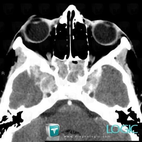 Rhabdomyosarcoma, Sinus, CT