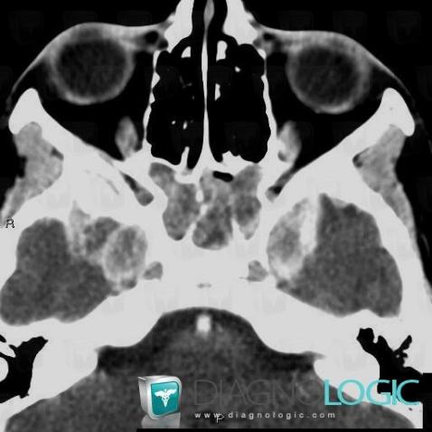 Rhabdomyosarcoma, Sinus, Deep facial spaces, CT