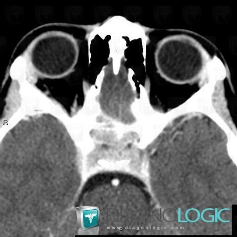 Rhabdomyosarcoma, Sphenoid bone, CT